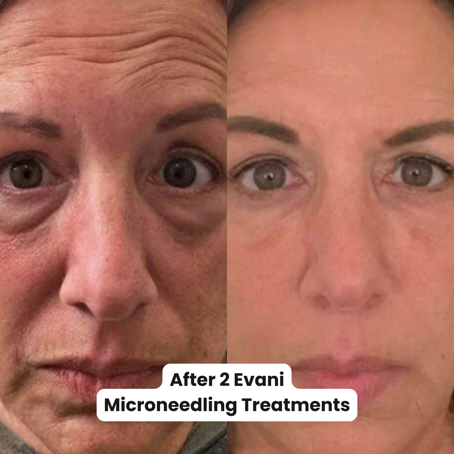 M8S Microneedling Pen + 30 Cartridges & Serum Free - Limited Time Offer