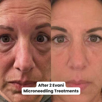 M8S Microneedling Pen + 30 Cartridges & Serum Free - Limited Time Offer