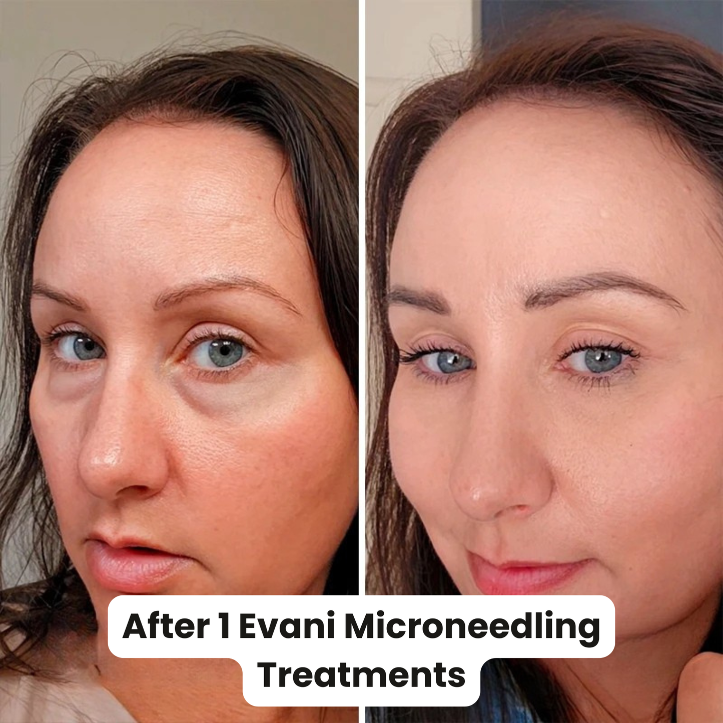 M8S Microneedling Pen + 30 Cartridges & Serum Free - Limited Time Offer