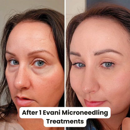 M8S Microneedling Pen + 30 Cartridges & Serum Free - Limited Time Offer