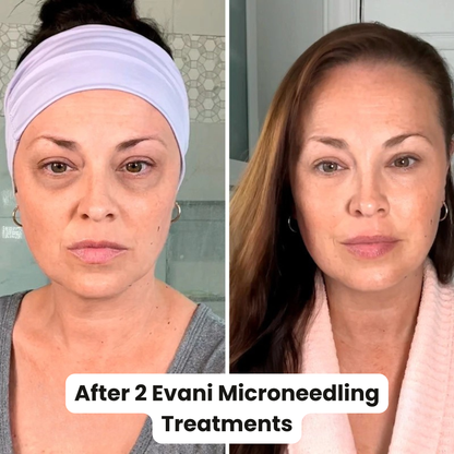 M8S Microneedling Pen + 30 Cartridges & Serum Free - Limited Time Offer