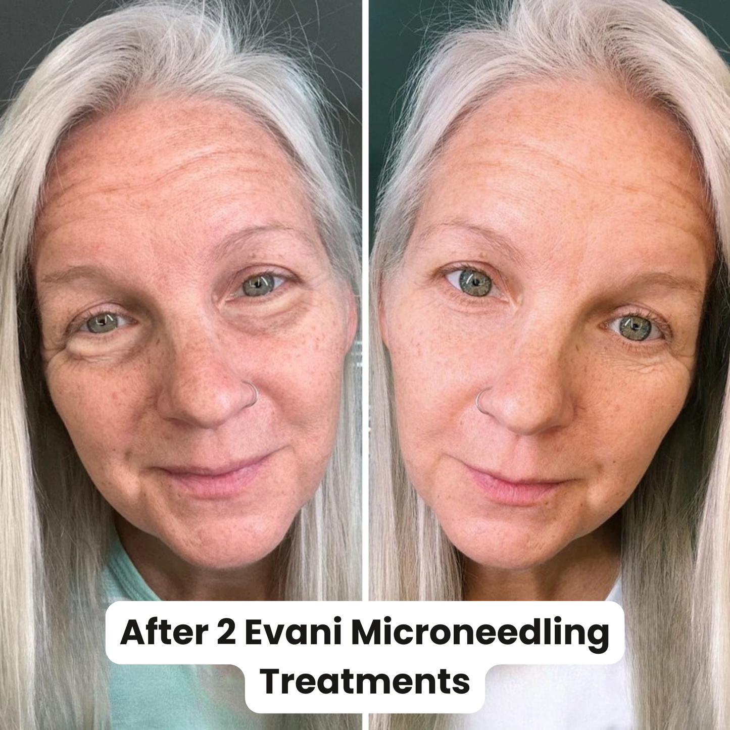 M8S Microneedling Pen + 30 Cartridges & Serum Free - Limited Time Offer